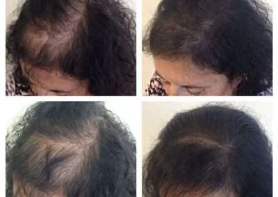 scalp-micro-pigmentation-bangkok