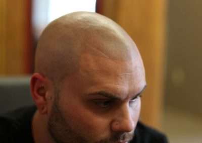 scalp-micro-pigmentation-bangkok