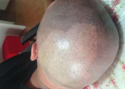 scalp-micro-pigmentation-bangkok