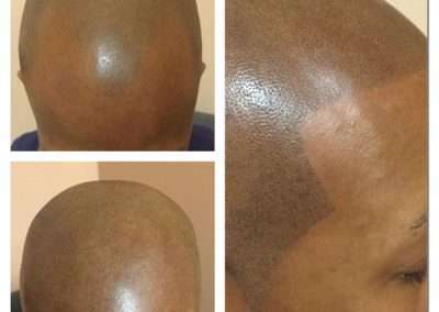 scalp-micro-pigmentation-bangkok